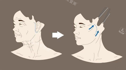 拉皮手术前后示意图