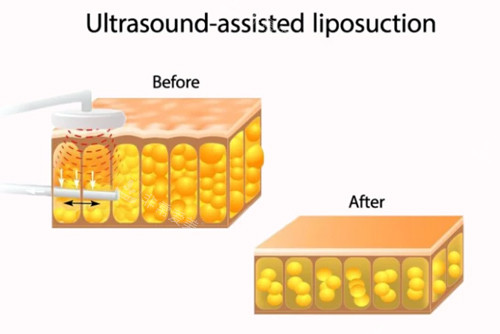 吸脂前后脂肪细胞图解