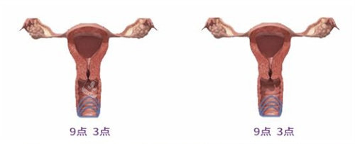 女性私密整形动画图