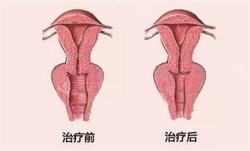 私密手术前后对比图