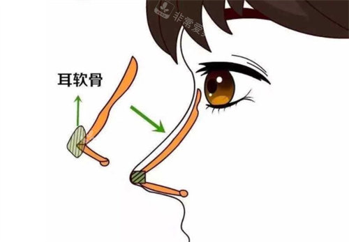 耳軟骨隆鼻動畫圖 耳軟骨隆鼻動畫圖