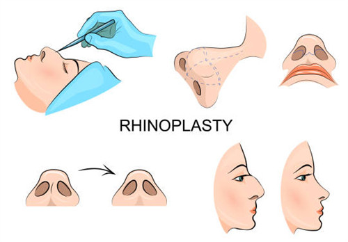 隆鼻手术过程图