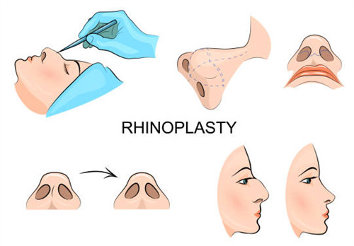 隆鼻手術(shù)過(guò)程圖
