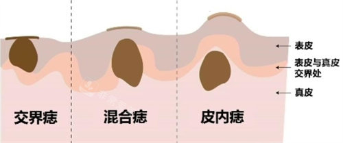 色素痣结构图