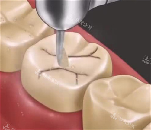 补牙的过程图解