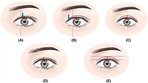 不同宽度的双眼皮