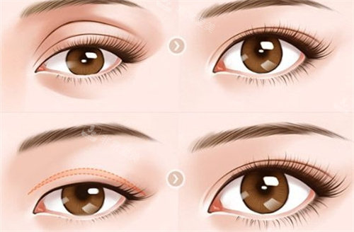 双眼皮动画图