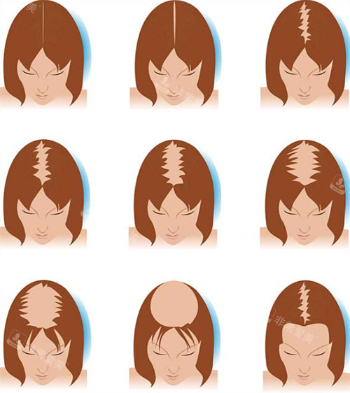 不同情況的毛發(fā)缺失 不同情況的毛發(fā)缺失