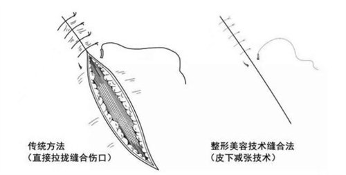 减张缝合手术