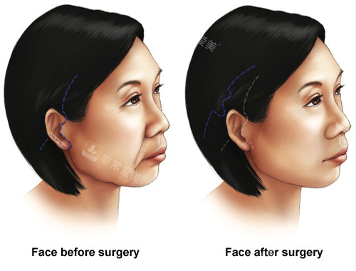 埋线提升手术前后对比图