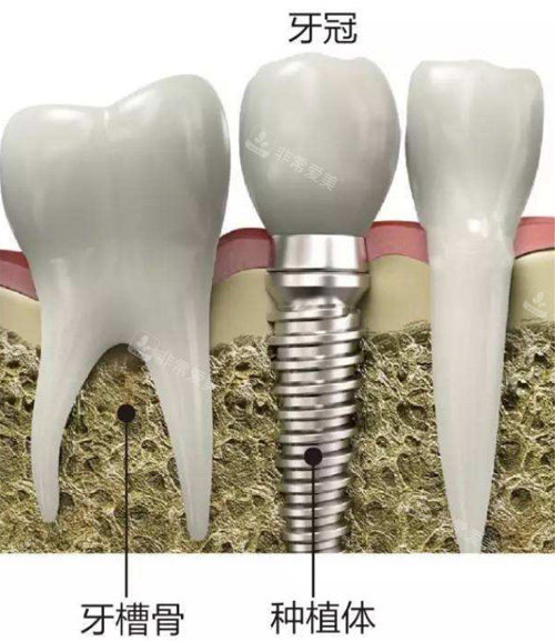 种植牙动画示意图展示