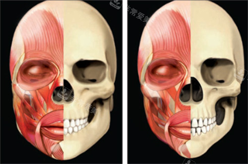 下颌整形前后区别对比图