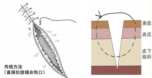 疤痕缝合原理图
