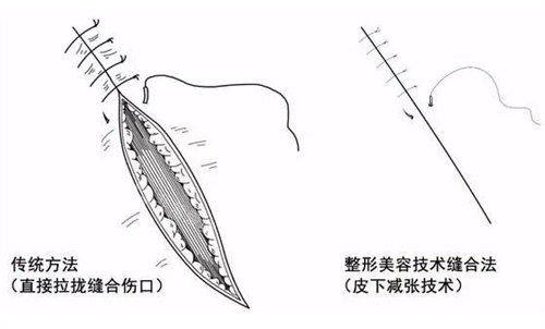 伤口减张缝合示意图