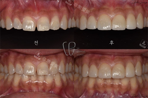 韓國le牙科醫(yī)院牙瓷貼面對比圖