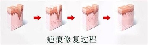 ​广州长安医院疤痕科怎么样，疤痕修复去胎记技术十分出色！