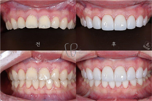 韩国le牙科贴面前后照片.jpg