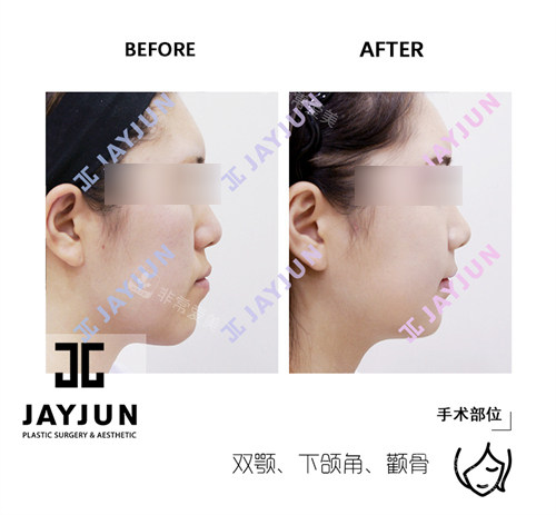 JAYJUN捷埈整形外科&皮膚科面部輪廓手術前后對比圖 JAYJUN捷埈整形外科&皮膚科面部輪廓手術前后對比圖