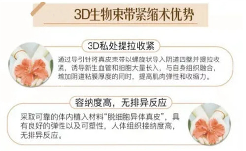 3D生物束带紧缩术的优势图解