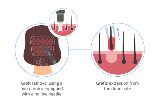 毛发移植过程图解