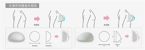 不同形狀的隆胸假體