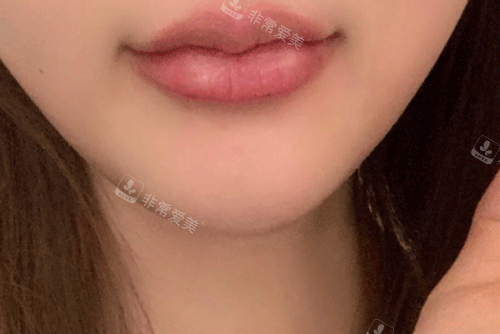 玻尿酸填充下巴照片