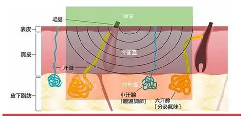 除腋臭原理图