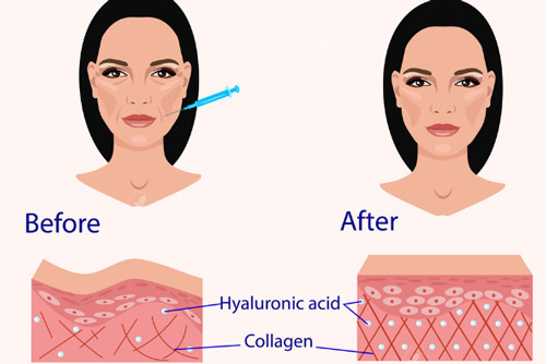 注射玻尿酸前后对比图