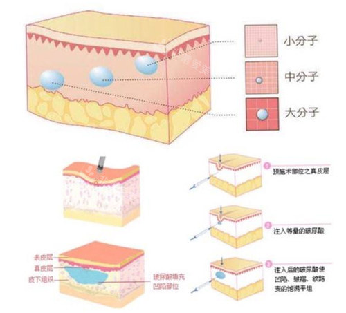 玻尿酸注射原理