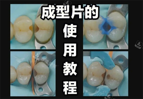 补牙操作流程图解