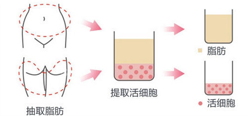 脂肪填充过程图