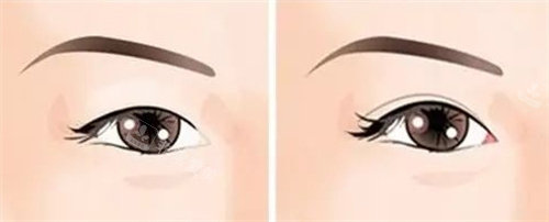 双眼皮动画图