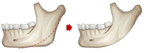 下颌角截骨动画图