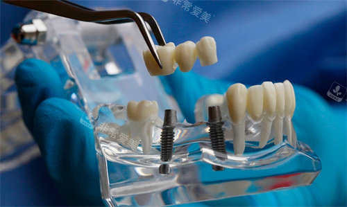 种植牙模型图