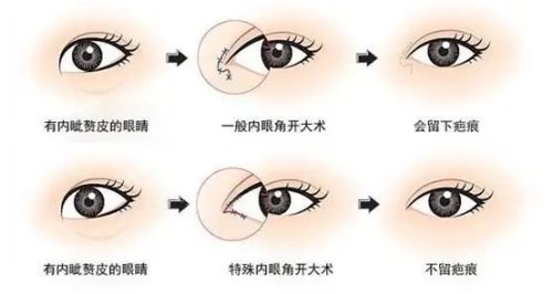 开眼角示意图