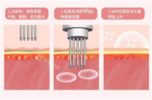 注射水光的過(guò)程圖解