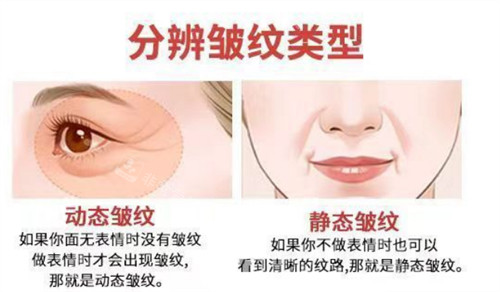 不同皺紋類(lèi)型圖解 不同皺紋類(lèi)型圖解