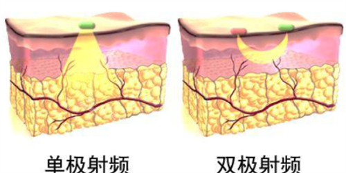 不同激光儀器探頭作用對(duì)比圖 不同激光儀器探頭作用對(duì)比圖
