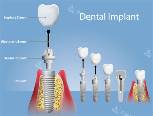 种植牙组成部分图解