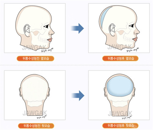 韓國雕刻整形醫(yī)院后腦勺填充手術動畫圖