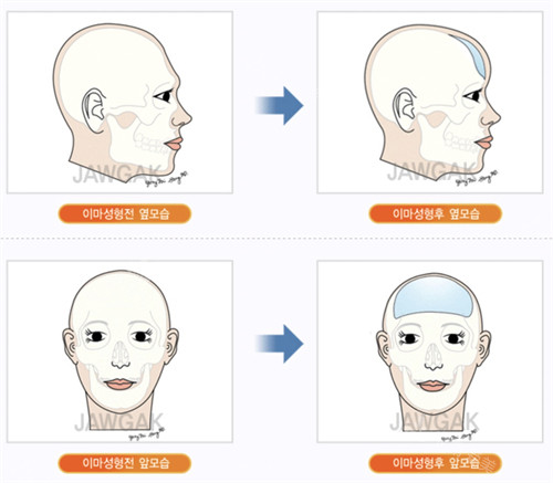 韩国雕刻整形医院颅顶填充手术动画图