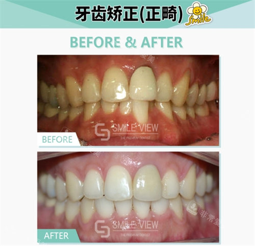 韓國江南SMILE VIEW牙科正畸對比圖