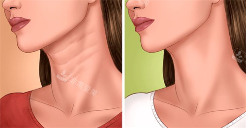 改善颈纹前后对比图