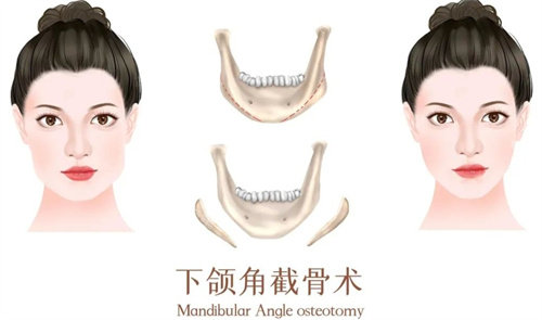 下颌角截骨术前后对比图