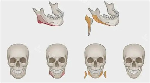 下颌角截骨手术流程图