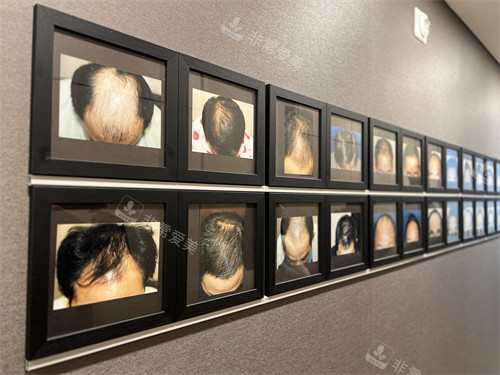 韩国毛多毛毛发移植医院植发对比照展示墙