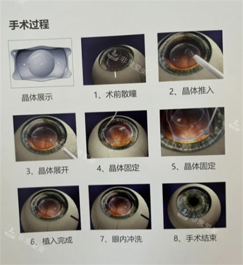 icl晶体植入手术过程图解