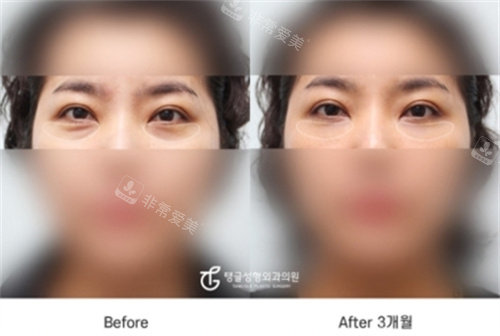 韩国TANGGLE整形祛眼袋术前术后对比图