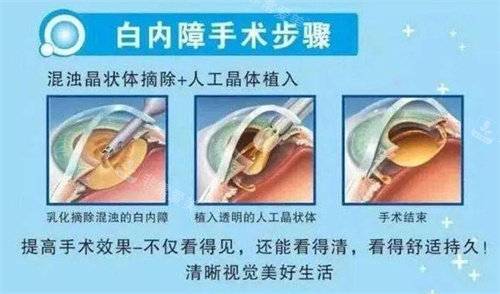 白内障手术示意图