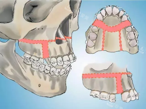 正颌手术示意图